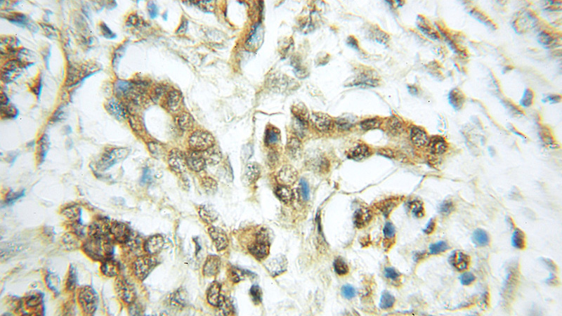 Immunohistochemical of paraffin-embedded human pancreas cancer using Catalog No:114473(RASEF antibody) at dilution of 1:50 (under 10x lens)