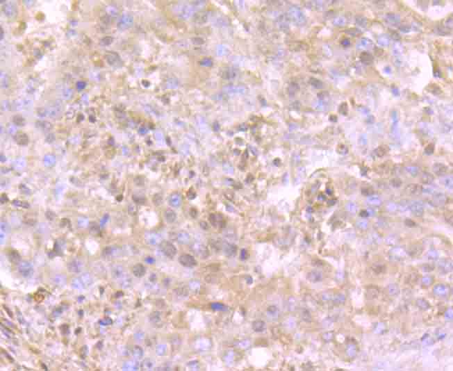 Fig4: Immunohistochemical analysis of paraffin-embedded human stomach cancer tissue using anti-TrkA antibody. Counter stained with hematoxylin.