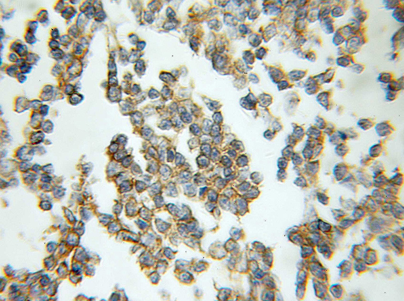 Immunohistochemical of paraffin-embedded human lymphoma using Catalog No:114432(RAB33A antibody) at dilution of 1:50 (under 10x lens)