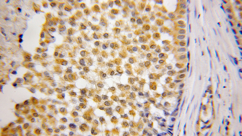 Immunohistochemical of paraffin-embedded human breast cancer using Catalog No:110483(ETFA antibody) at dilution of 1:50 (under 40x lens)