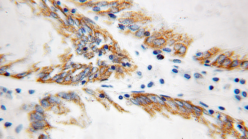 Immunohistochemical of paraffin-embedded human colon cancer using Catalog No:115818(SUCLA2 antibody) at dilution of 1:100 (under 10x lens)