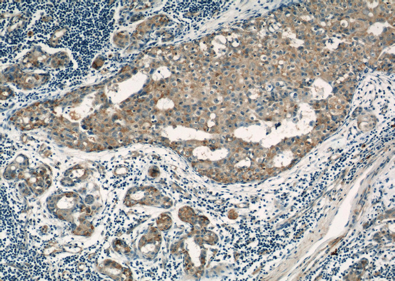 Immunohistochemical of paraffin-embedded human breast cancer using Catalog No:112155(LATH antibody) at dilution of 1:50 (under 10x lens)