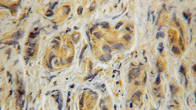 Immunohistochemical of paraffin-embedded human prostate cancer using Catalog No:116233(TRAF5 antibody) at dilution of 1:100 (under 10x lens)