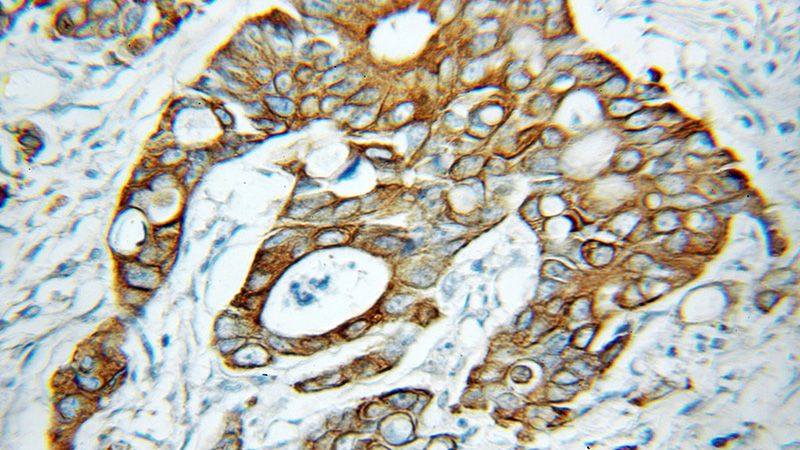 Immunohistochemical of paraffin-embedded human colon cancer using Catalog No:112136(KRT81 antibody) at dilution of 1:50 (under 10x lens)