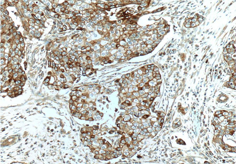 Immunohistochemistry of paraffin-embedded human breast cancer tissue slide using Catalog No:109414(MET Antibody) at dilution of 1:50 (under 10x lens)