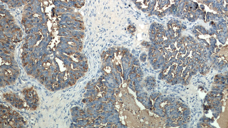 Immunohistochemical of paraffin-embedded human ovary tumor using Catalog No:112887(CA15-3,MUC1 antibody) at dilution of 1:50 (under 10x lens)