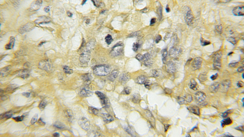 Immunohistochemical of paraffin-embedded human gliomas using Catalog No:114453(RAB5A antibody) at dilution of 1:50 (under 10x lens)