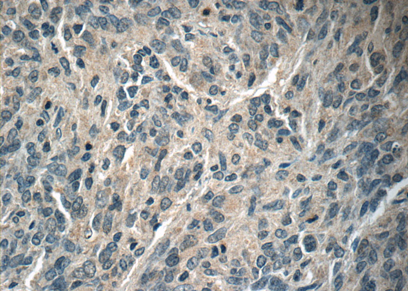 Immunohistochemistry of paraffin-embedded human gliomas tissue slide using Catalog No:107343(NUMBLIKE Antibody) at dilution of 1:50 (under 40x lens)