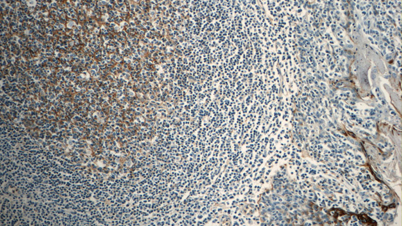 Immunohistochemistry of paraffin-embedded human tonsillitis tissue slide using Catalog No:109410(CLU Antibody) at dilution of 1:50 (under 10x lens)