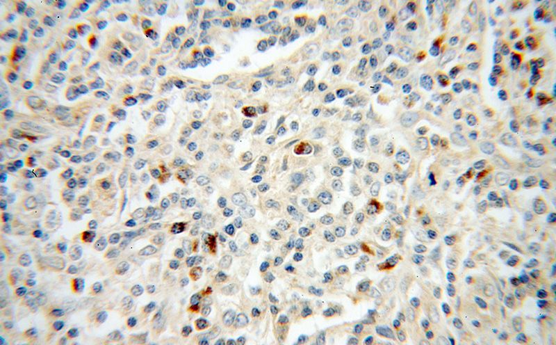 Immunohistochemical of paraffin-embedded human lymphoma using Catalog No:116351(TRAV20 antibody) at dilution of 1:50 (under 40x lens)