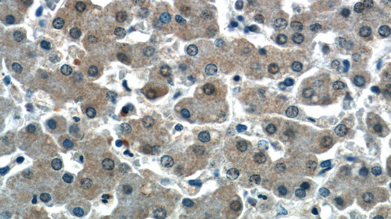 Immunohistochemistry of paraffin-embedded human liver slide using Catalog No:115803(SDCBP Antibody) at dilution of 1:50 (under 40x lens)