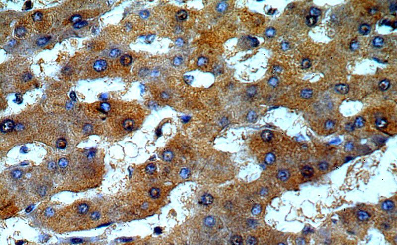 Immunohistochemical of paraffin-embedded human hepatocirrhosis using Catalog No:107880(ALPK1 antibody) at dilution of 1:50 (under 40x lens)
