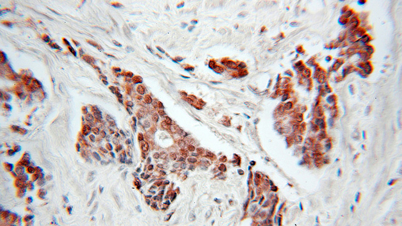 Immunohistochemical of paraffin-embedded human prostate cancer using Catalog No:109102(CDC34 antibody) at dilution of 1:100 (under 10x lens)