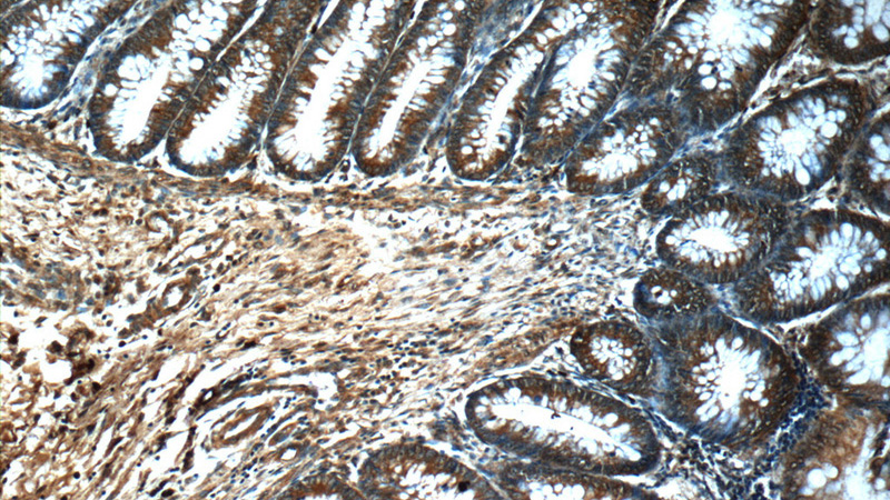 Immunohistochemistry of paraffin-embedded human colon slide using Catalog No:107482(PRDX4 Antibody) at dilution of 1:50(unde10x lens)