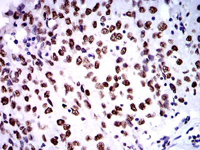 Fig5: Immunohistochemical analysis of paraffin-embedded human ovarian cancer tissue using anti-ZFP91 antibody. Counter stained with hematoxylin.