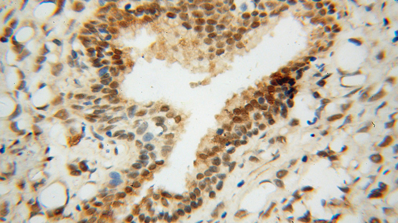 Immunohistochemical of paraffin-embedded human prostate cancer using Catalog No:114710(RING1 antibody) at dilution of 1:50 (under 40x lens)