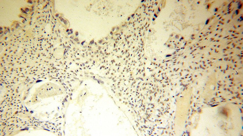 Immunohistochemical of paraffin-embedded human ovary tumor using Catalog No:115522(SP100 antibody) at dilution of 1:50 (under 10x lens)