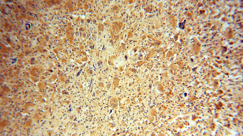 Immunohistochemical of paraffin-embedded human gliomas using Catalog No:113198(CDKL3 antibody) at dilution of 1:50 (under 10x lens)