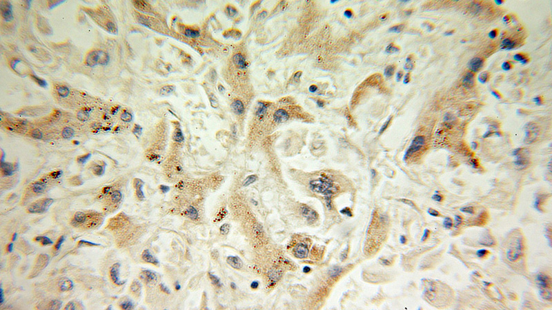 Immunohistochemical of paraffin-embedded human pancreas cancer using Catalog No:114177(PRDX4 antibody) at dilution of 1:100 (under 10x lens)