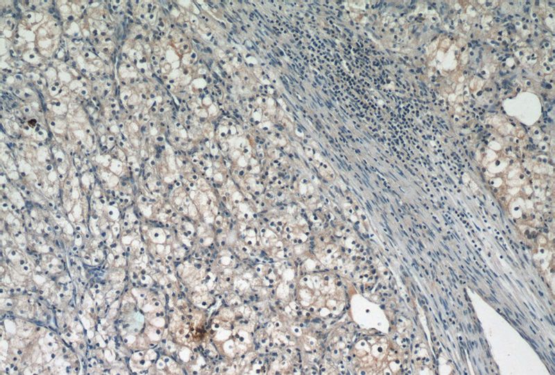 Immunohistochemistry of paraffin-embedded human renal cell carcinoma tissue slide using Catalog No:113907(PIN1 Antibody) at dilution of 1:50 (under 10x lens)