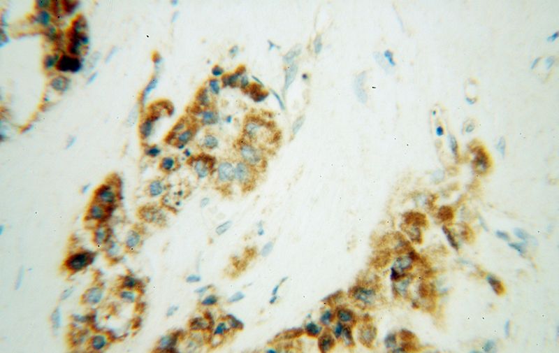 Immunohistochemical of paraffin-embedded human liver cancer using Catalog No:116639(UQCRQ antibody) at dilution of 1:100 (under 40x lens)