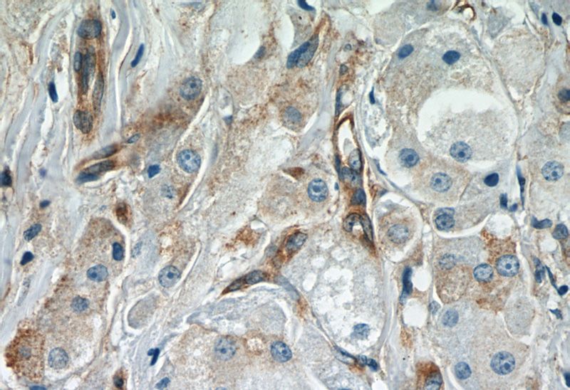 Immunohistochemistry of paraffin-embedded human breast cancer slide using Catalog No:108041(APPL1 Antibody) at dilution of 1:50