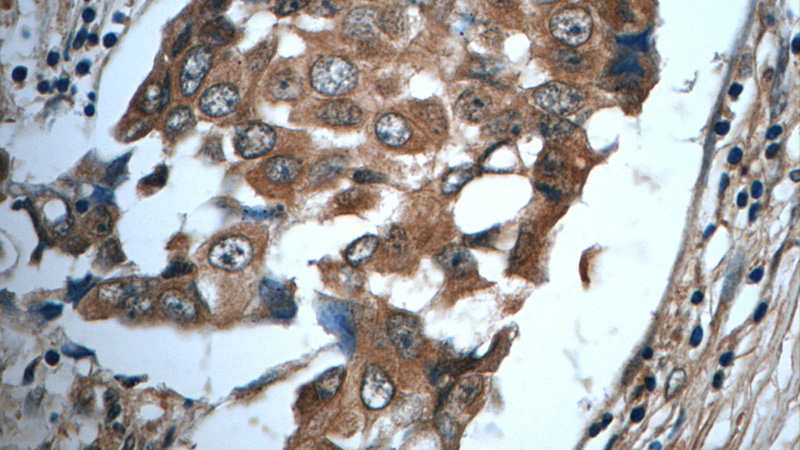 Immunohistochemistry of paraffin-embedded human breast cancer tissue slide using Catalog No:111769(IL19 Antibody) at dilution of 1:50 (under 40x lens)