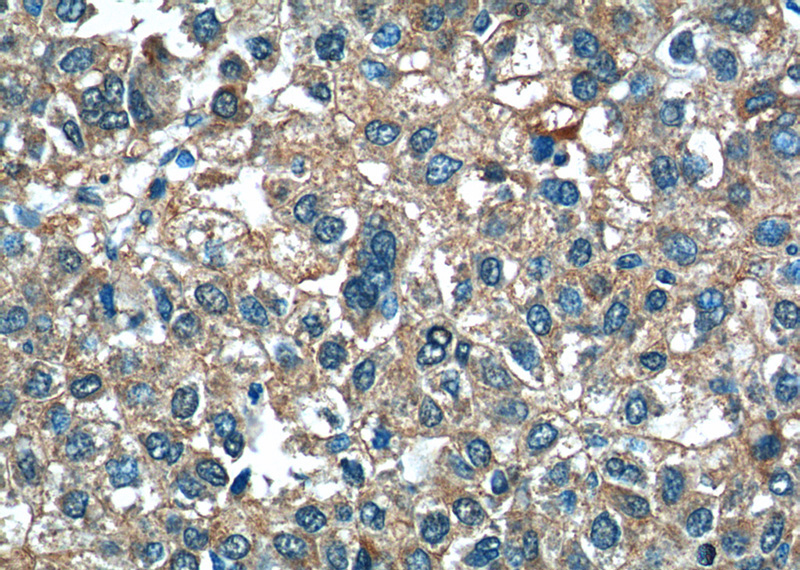 Immunohistochemistry of paraffin-embedded human liver cancer tissue slide using Catalog No:107961(ALDH1A3 Antibody) at dilution of 1:50 (under 40x lens)