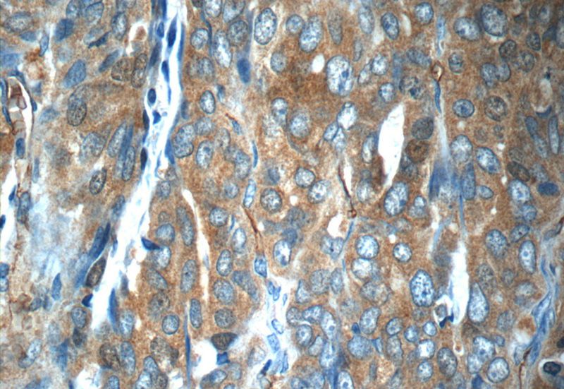 Immunohistochemistry of paraffin-embedded human ovary tumor slide using Catalog No:116968(ZNF259 Antibody) at dilution of 1:50