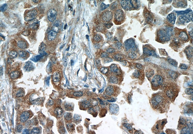 Immunohistochemistry of paraffin-embedded human lung cancer tissue slide using Catalog No:107504(EBAG9 Antibody) at dilution of 1:50. Heat mediated antigen retrieved with Citric acid buffer, pH6.0.