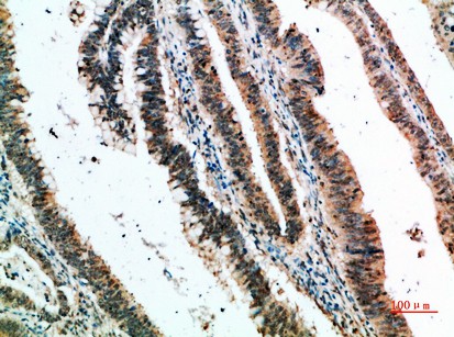 Fig2:; Immunohistochemical analysis of paraffin-embedded human-colon-cancer, antibody was diluted at 1:200