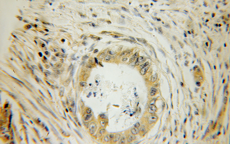 Immunohistochemical of paraffin-embedded human colon cancer using Catalog No:111176(GSPT2 antibody) at dilution of 1:100 (under 10x lens)