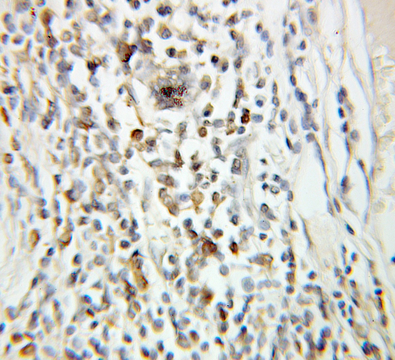 Immunohistochemical of paraffin-embedded human breast cancer using Catalog No:110942(GMNN antibody) at dilution of 1:100 (under 10x lens)