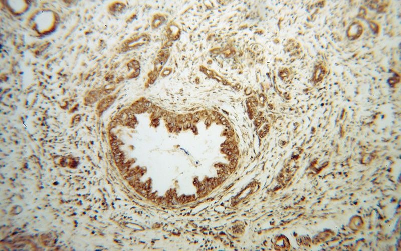 Immunohistochemical of paraffin-embedded human pancreas cancer using Catalog No:110314(EEF1D antibody) at dilution of 1:100 (under 10x lens)