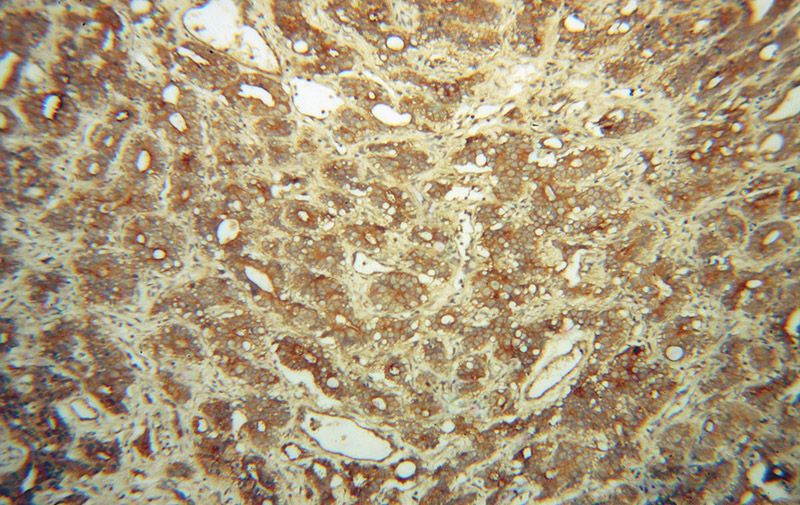 Immunohistochemical of paraffin-embedded human gliomas using Catalog No:110726(FMN2 antibody) at dilution of 1:100 (under 10x lens)