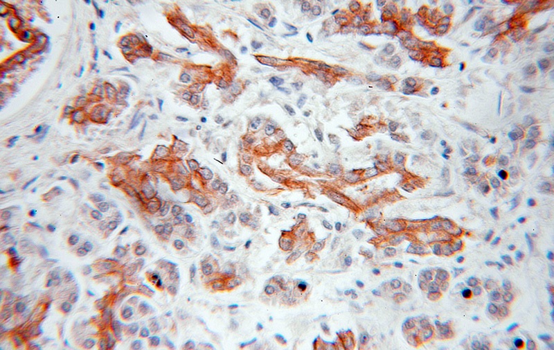 Immunohistochemical of paraffin-embedded human pancreas cancer using Catalog No:108976(CCDC5 antibody) at dilution of 1:50 (under 10x lens)