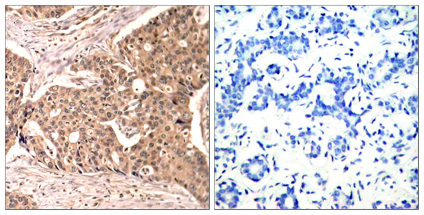 Immunohistochemical analysis of paraffin-embedded human breast carcinoma tissue using Paxillin (Phospho-Tyr118) Antibody  (left) or the same antibody preincubated with blocking peptide (right).