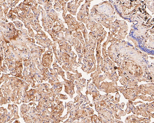 Fig2:; Immunohistochemical analysis of paraffin-embedded human lung tissue using anti-GSDMC antibody. The section was pre-treated using heat mediated antigen retrieval with Tris-EDTA buffer (pH 8.0-8.4) for 20 minutes.The tissues were blocked in 5% BSA for 30 minutes at room temperature, washed with ddH; 2; O and PBS, and then probed with the primary antibody ( 1/200) for 30 minutes at room temperature. The detection was performed using an HRP conjugated compact polymer system. DAB was used as the chromogen. Tissues were counterstained with hematoxylin and mounted with DPX.
