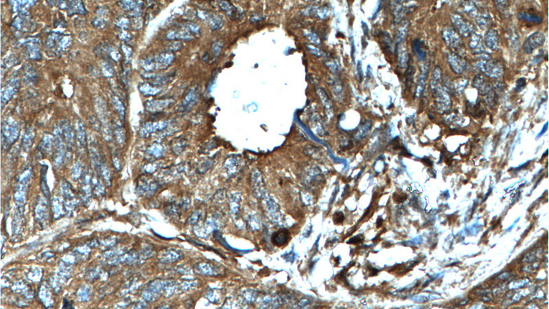 Immunohistochemistry of paraffin-embedded human colon cancer tissue slide using Catalog No:109126(CD46 Antibody) at dilution of 1:200 (under 40x lens). heat mediated antigen retrieved with Tris-EDTA buffer(pH9).