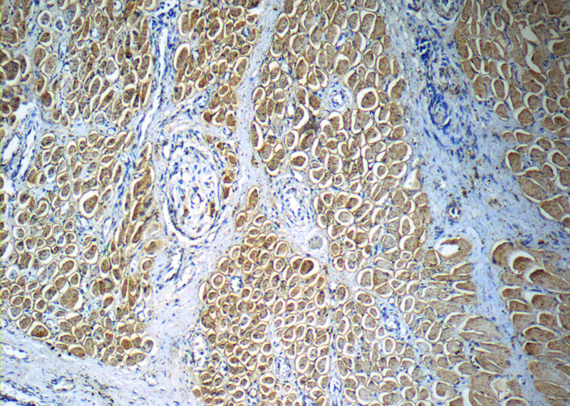 Immunohistochemistry of paraffin-embedded human osteosarcoma slide using Catalog No:113504(Osteocalcin Antibody) at dilution of 1:50