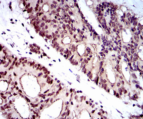 Fig5: Immunohistochemical analysis of paraffin-embedded human colon cancer tissue using anti-WHSC2 antibody. Counter stained with hematoxylin.