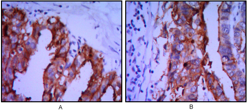 Immunohistochemical analysis of paraffin-embedded ovarian cancer (A), stomach cancer (B) using ALPP mouse mAb with DAB staining.