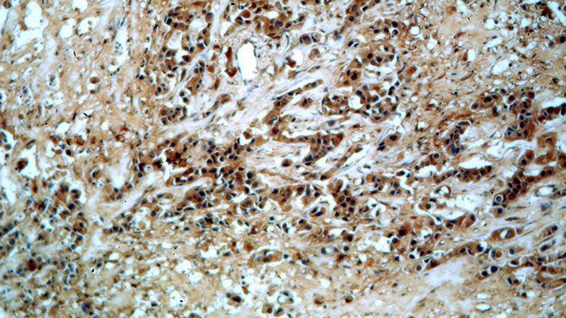 Immunohistochemical of paraffin-embedded human breast cancer using Catalog No:110888(GBA antibody) at dilution of 1:50 (under 10x lens)