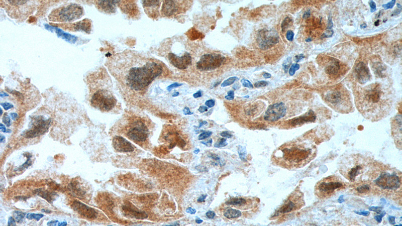 Immunohistochemistry of paraffin-embedded human lung cancer tissue slide using Catalog No:109161(CDK4 Antibody) at dilution of 1:200 (under 40x lens). heat mediated antigen retrieved with Tris-EDTA buffer(pH9).