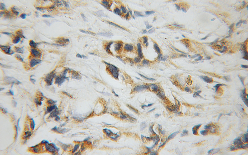 Immunohistochemical of paraffin-embedded human prostate cancer using Catalog No:116519(UBE2D3 antibody) at dilution of 1:100 (under 10x lens)
