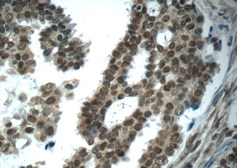 Immunohistochemistry of paraffin-embedded human ovary tumor tissue slide using Catalog No:107655(ubiquitin Antibody) at dilution of 1:50 (under 40x lens)