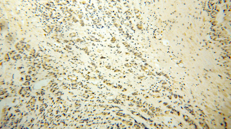 Immunohistochemical of paraffin-embedded human gliomas using Catalog No:109964(DNM3 antibody) at dilution of 1:50 (under 10x lens)