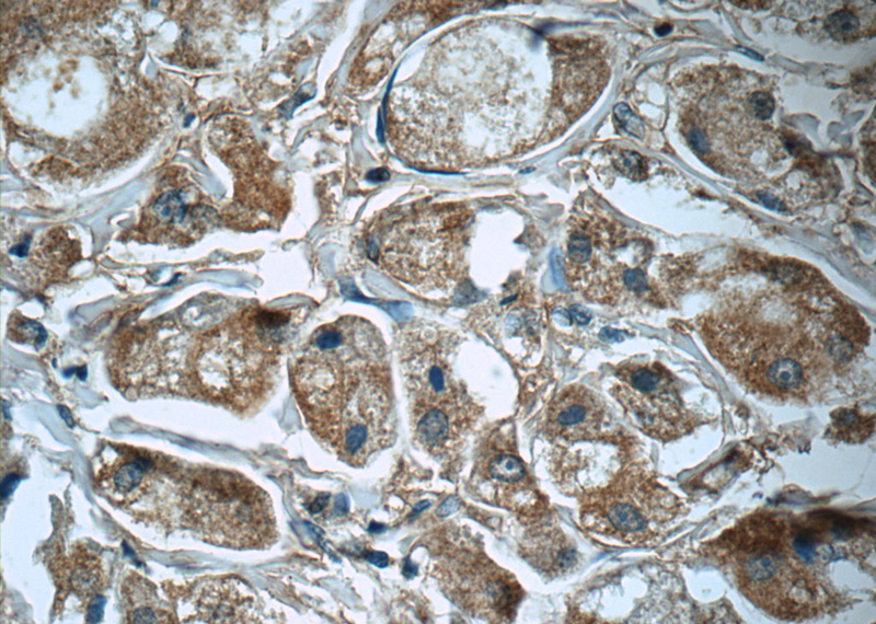 Immunohistochemistry of paraffin-embedded human breast cancer tissue slide using Catalog No:113722(Prx III Antibody) at dilution of 1:50 (under 40x lens)