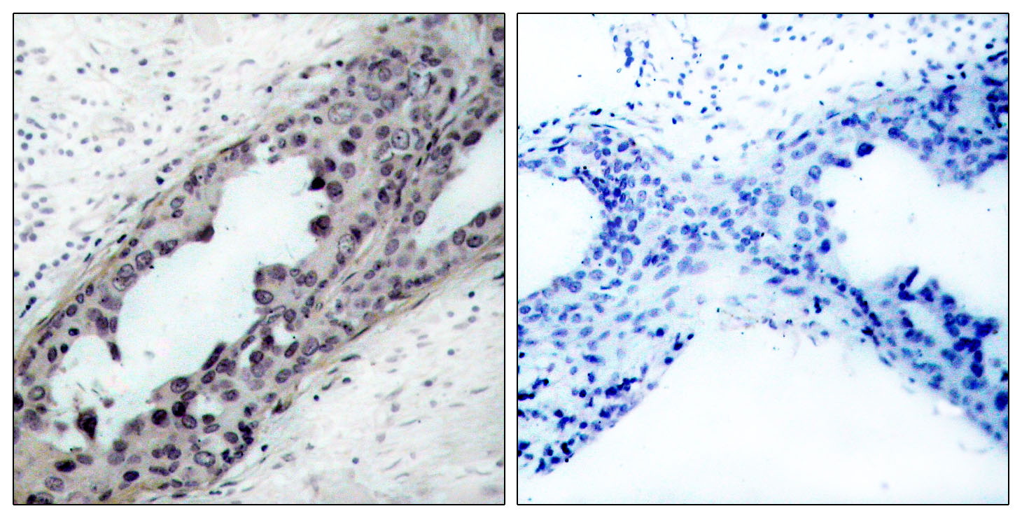Immunohistochemical analysis of paraffin-embedded human breast carcinoma tissue, using PTEN (Phospho-Ser380/Thr382/Thr383) Antibody  (left) or the same antibody preincubated with blocking peptide (right).