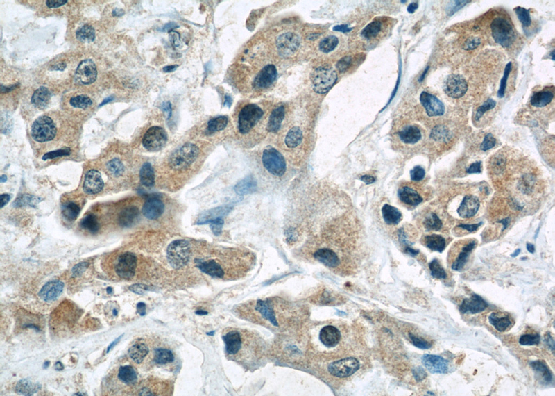 Immunohistochemical of paraffin-embedded human breast cancer using Catalog No:107418(MCL1 antibody) at dilution of 1:50 (under 40x lens)